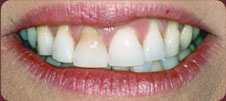 plaque covered teeth before