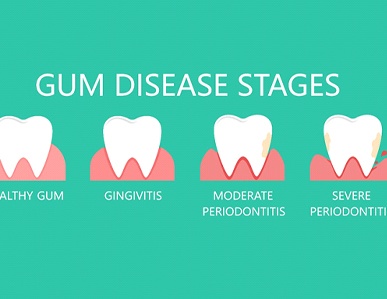 The various stages of gum disease