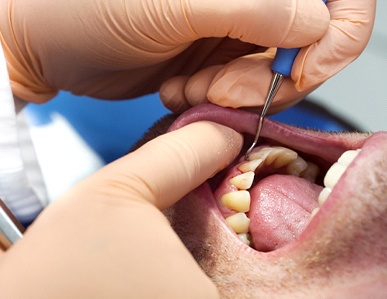 A male patient undergoing scaling and root planing to clear away plaque and harmful bacteria beneath the gum line
