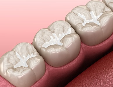 A 3D illustration of a dental sealant