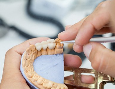 Traditional dental bridge in Superior being placed in mouth