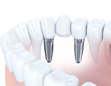 Graphic showing traditional dental bridge on white background