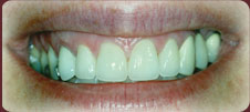 teeth after whitening