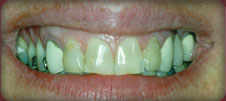 Yellow teeth before whitening