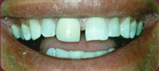 Gap before procedure