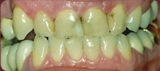 decayed covered teeth before
