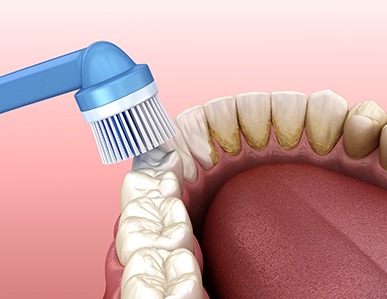 Electric cleaning tool being used to remove plaque from teeth