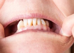 closeup of a mouth missing multiple teeth