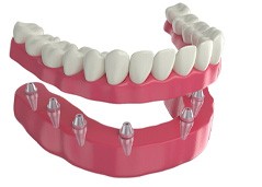 diagram of implant dentures