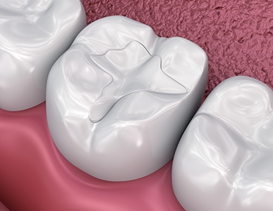 Illustration of a tooth-colored filling in lower tooth