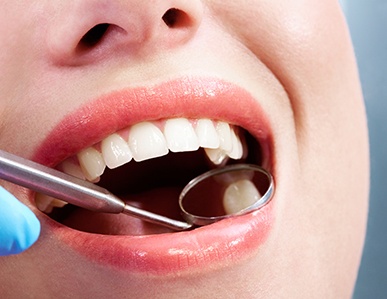 Closeup of dental mirror reflecting someone’s tooth