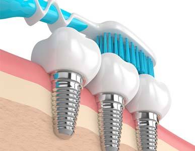 Diagram showing how to care for dental implants in Superior