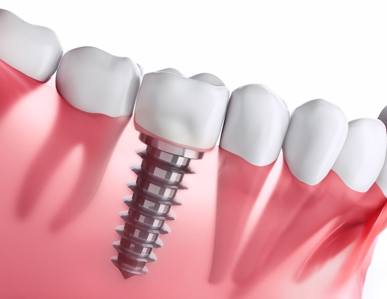 Diagram of dental implants in Superior