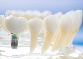 Model teeth and jaw with dental implant in Superior