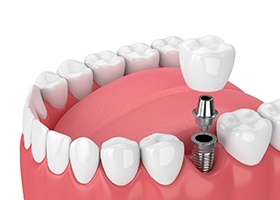 3D illustration of a smile with a dental implant, abutment, and crown
