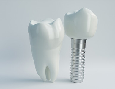 Dental implant in Superior juxtaposed next to model of natural tooth