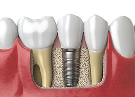 Diagram of dental implant after surgery
