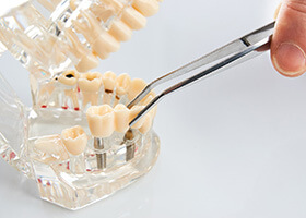 Diagram of dental implants in Superior