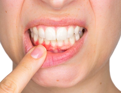 An up-close view of a person pulling down their lower lip to expose their red and swollen oral tissue that needs gum disease treatment in Superior