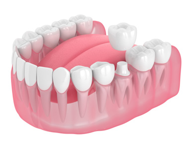 Illustration of dental crown