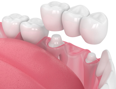 Illustration of dental bridge
