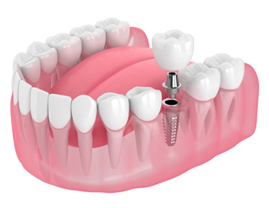 Illustration of dental implant