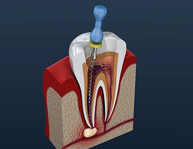 Image showing root canal procedure