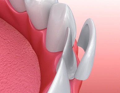 Model of veneer on bottom tooth