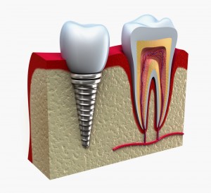 dental implants