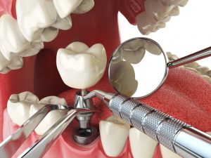 dental implant illustration