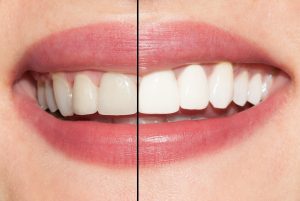 Image of the results of teeth whitening.