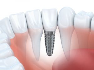 A diagram of a dental implant.