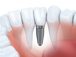 A diagram of a dental implant.