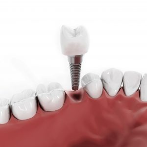 model of dental implant