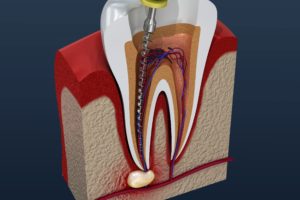 Model of root canal for infected tooth