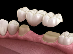 Dental bridge of three teeth over molar and premolar