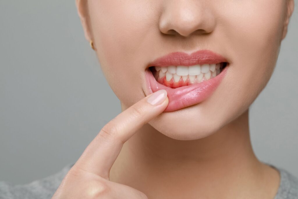 Nose-to-neck view of woman pulling down corner of bottom lip to reveal red gums