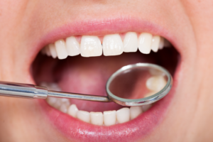 a close-up of a tooth with a metal-free filling