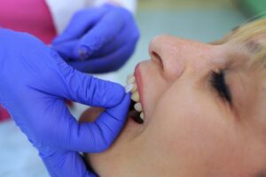 Dentist applying veneers to patient's teeth. 